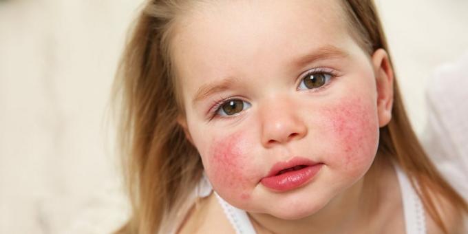 Обрив по лицето: хранителна алергия