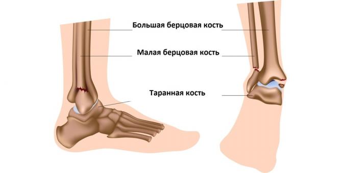 Фрактура на глезена засяга костите, които изграждат глезенната става